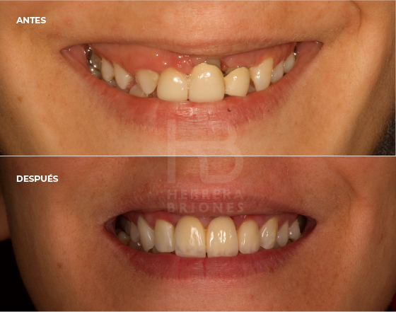 antes y después en estética dental