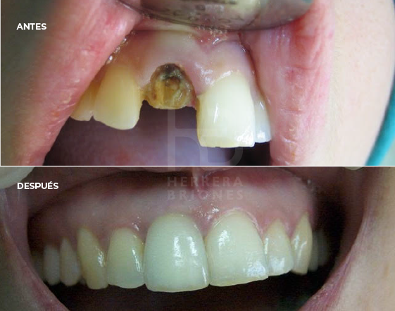Tratamiento de implantología dental