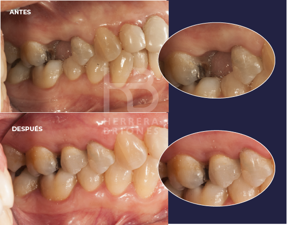 antes y después en implantes