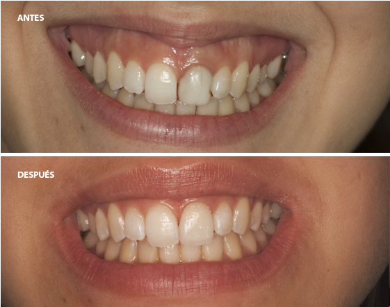 Tratamiento de estetica dental