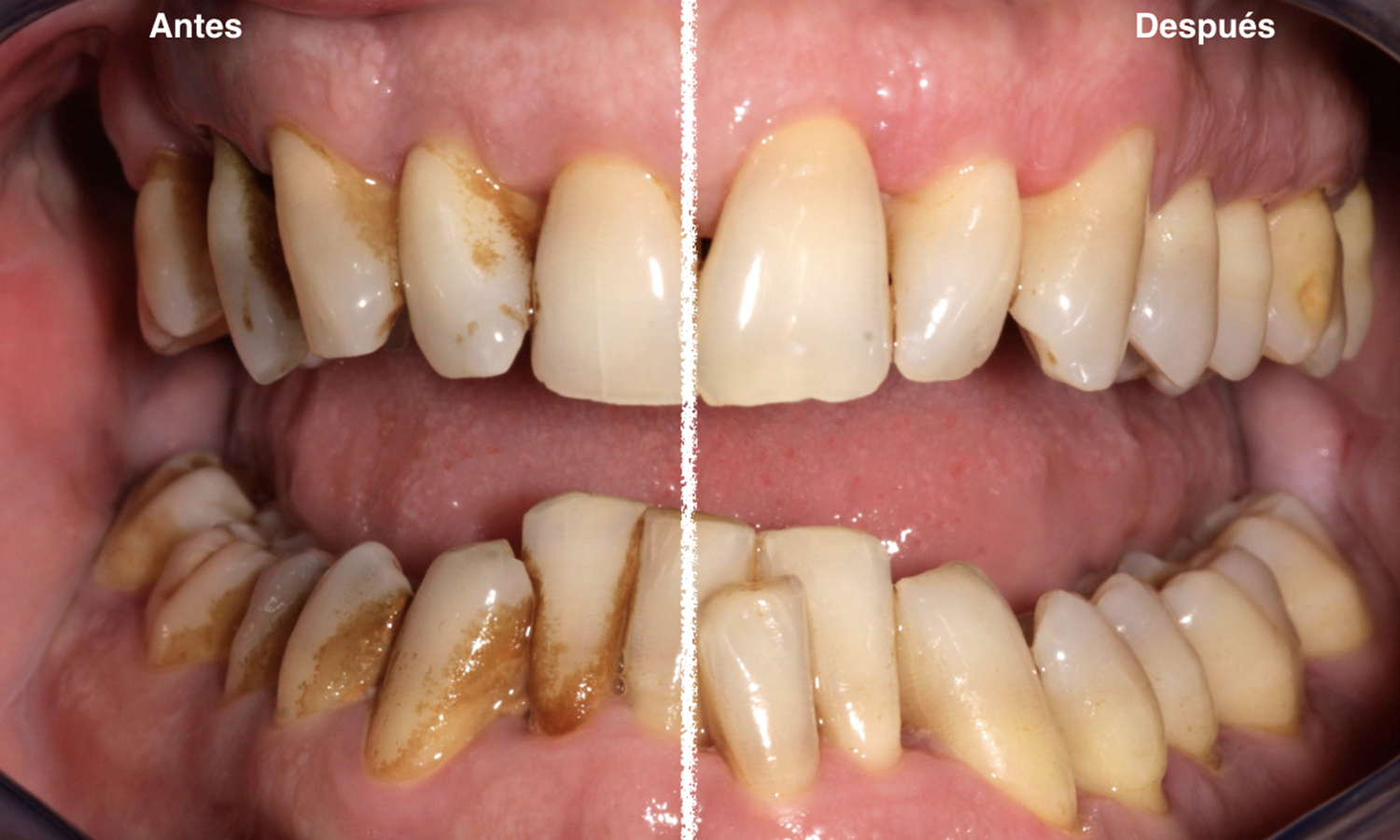 Tratamiento de gingivitis