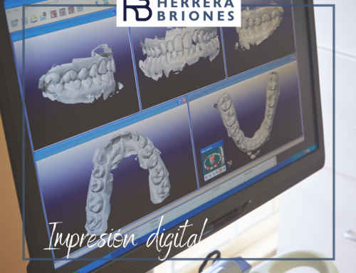 IMPRESIÓN DENTAL DIGITAL, QUÉ ES. VENTAJAS.