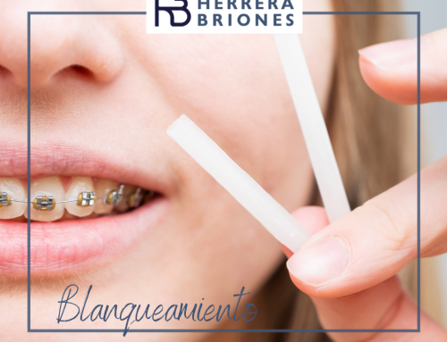 ¿SE PUEDE BLANQUEAR UN DIENTE CON ENDODONCIA?